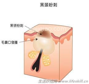 祛黑头，收毛孔，一招远离草莓鼻 