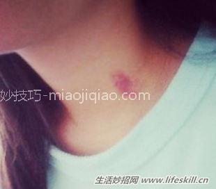 快速消除咬痕有妙招 