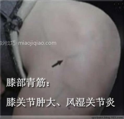 人体体表“青筋”凸起意味着什么?