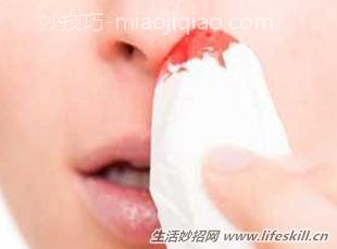 鼻出血的处理方法小知识 